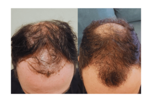 Failed Hair Transplant #1