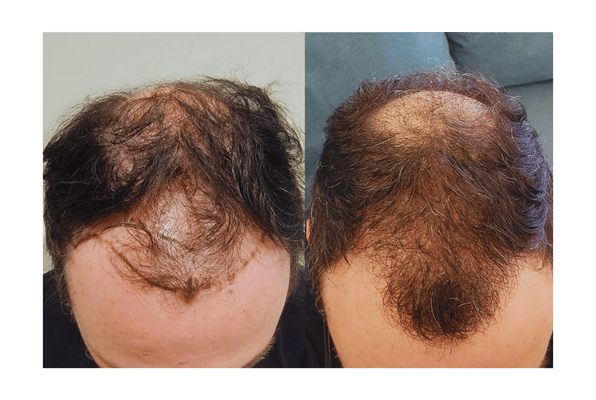 Failed Hair Transplant #1