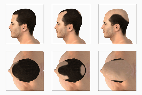 Hair Loss Genetics- Male Pattern Baldness Symptoms