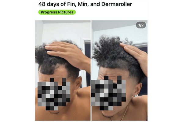 Hair Loss Genetics- Treatment Progress Example