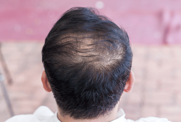 Hair Loss Advice for Men- Causes of Hair Loss Image- Balding Crown