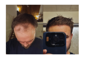 Successful Hair Transplant #1