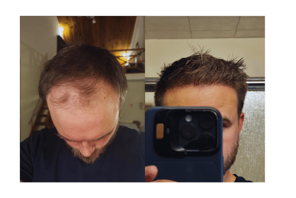 Successful Hair Transplant #1