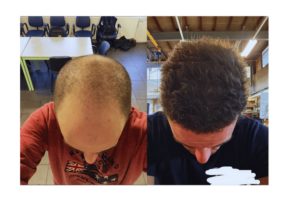 Successful Hair Transplant #2