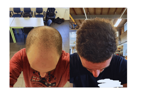 Successful Hair Transplant #2